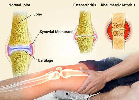 Eiceh® Radiofrequenz-Kräuter-Thermo-Kniepads