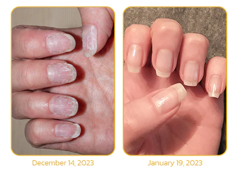 LIMETOW™ Peeling Nail Serum