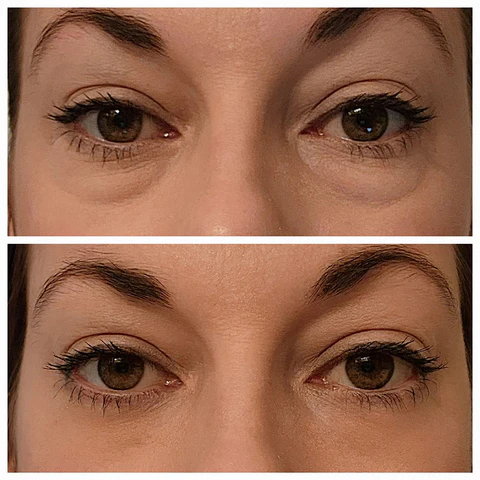 Oveallgo™ Clinical SkinCare Instant Eye Tightener