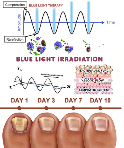 Oveallgo™ Expert Revolutionary High-Efficiency Light Therapy Device For Toenail Diseases