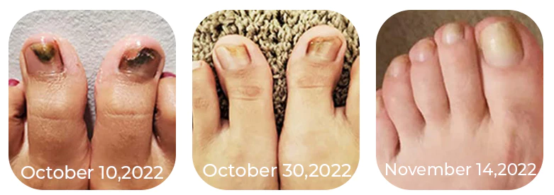 Oveallgo™ Expert Revolutionary High-Efficiency Light Therapy Device For Toenail Diseases