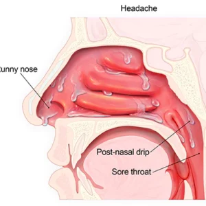 Oveallgo™ ULTRA Nasal Mucus Cleaning Device