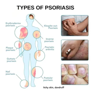 Seurico™ Psoriasis Treatment Spray