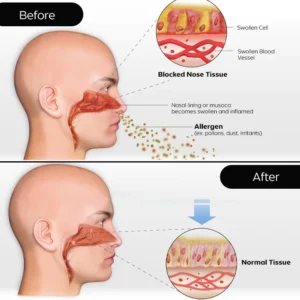 iRosesilk™ RespiRevive EMS Nasal Therapy Instrument