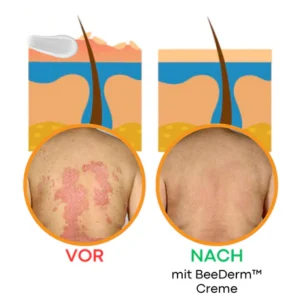 BeeDerm™ Bienengift Psoriasis Behandlungscreme