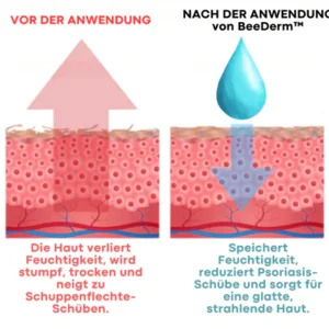 BeeDerm™ Bienengift Psoriasis Behandlungscreme