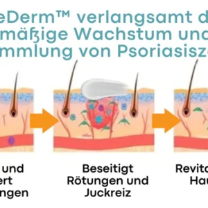 BeeDerm™ Bienengift Psoriasis Behandlungscreme