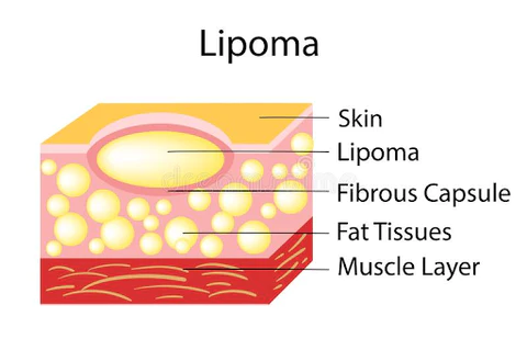 Cvreoz Lipoma Removal Cream