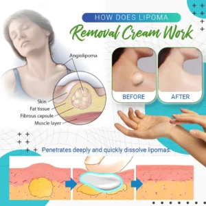 Cvreoz Lipoma Removal Cream