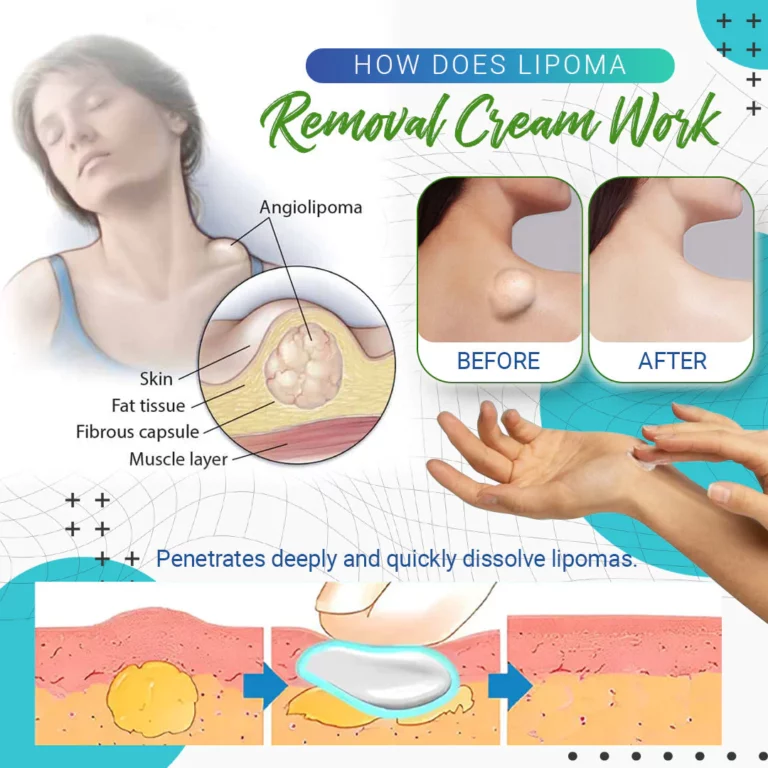 Cvreoz Lipoma Removal Cream