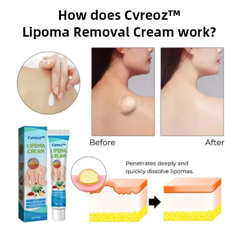 Cvreoz Lipoma Removal Cream