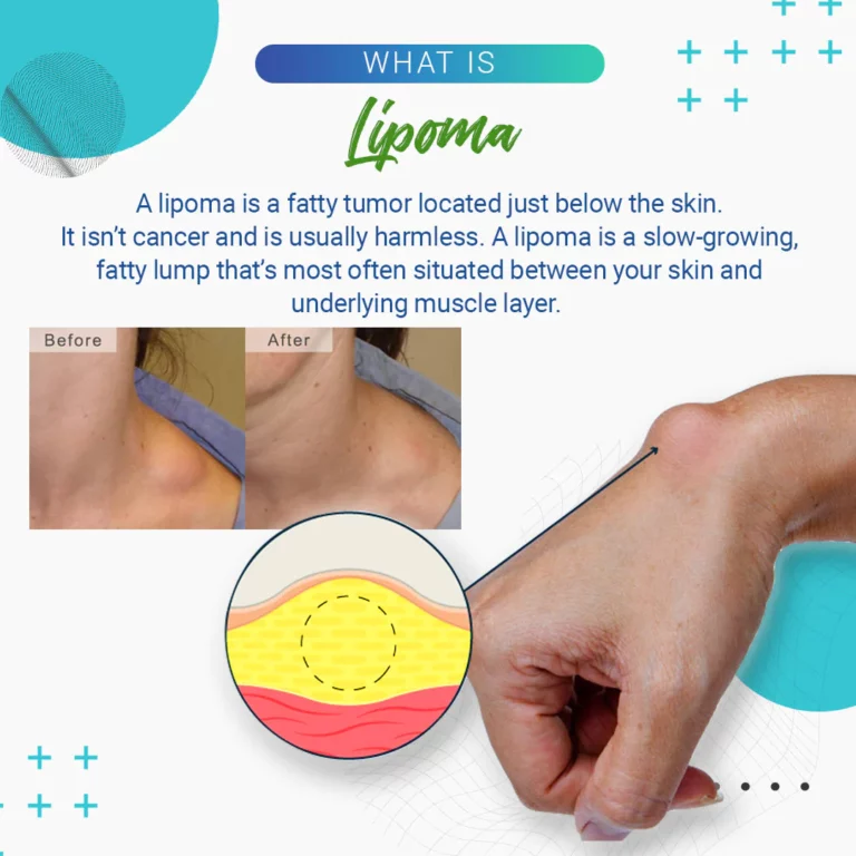 Cvreoz Lipoma Removal Cream