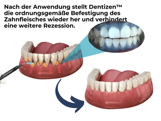 Dentizen™ Zahnfleisch Therapiemittel