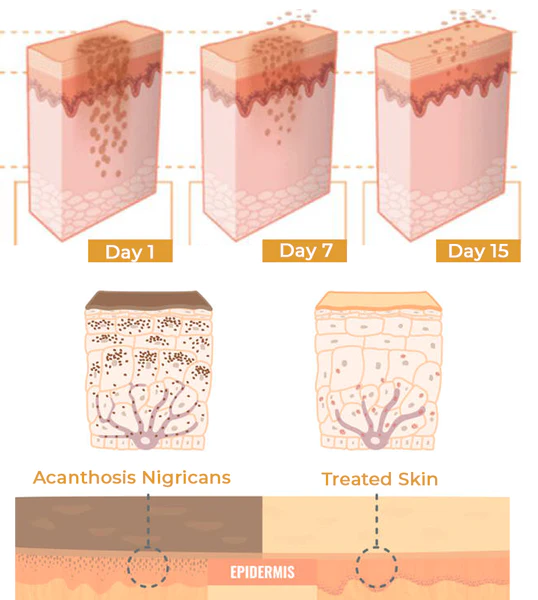 Dobshow™ Acanthosis Nigricans Hyperpigmentation Therapy Cream