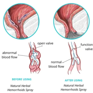 Dobshow™ Natural Herbal Hemorrhoids Spray