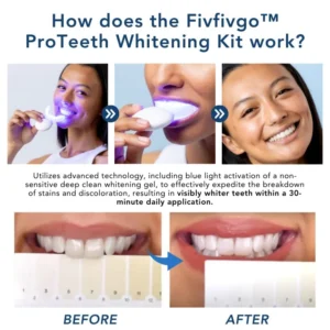 Oveallgo™ ProTeeth Whitening Kit