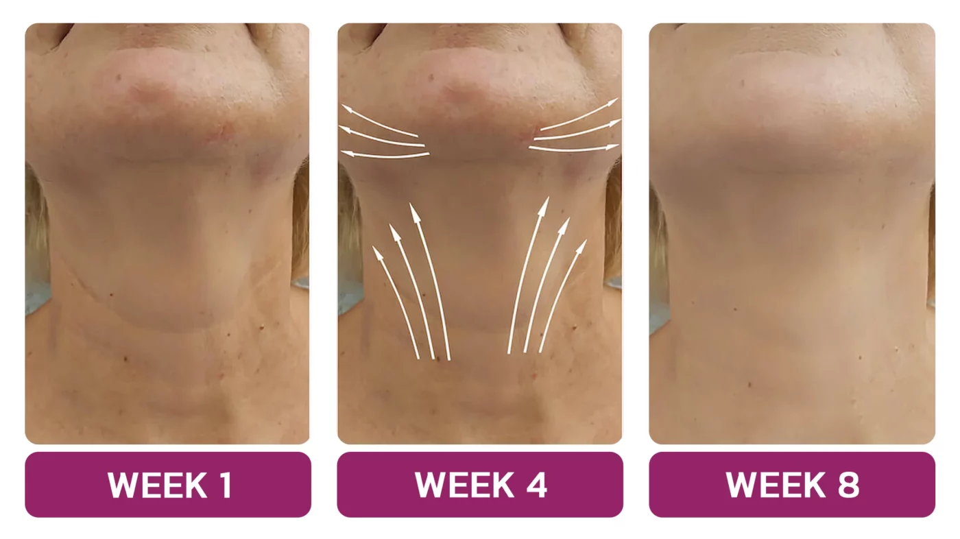 Furzero™ NECKUP Collagen Potentiating Neck Cream