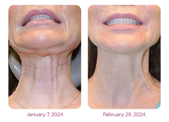 Furzero™ NECKUP Collagen Potentiating Neck Cream