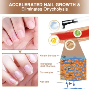 Kisshi™ OnycholysisHeal Nail Strengthening And Growth Conditioner