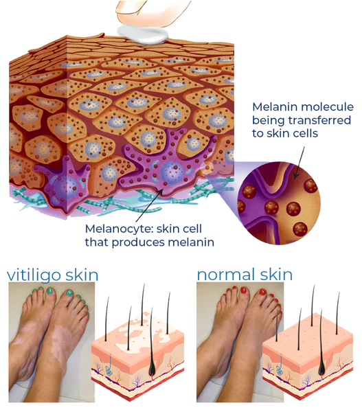 MelFix™ Vitiligo Therapy Cream
