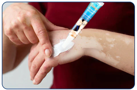 MelFix™ Vitiligo Therapy Cream
