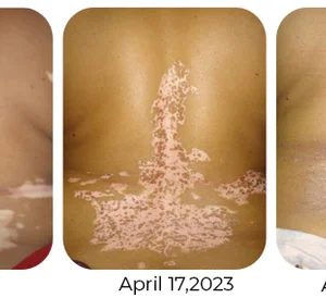 MelFix™ Vitiligo Therapy Cream