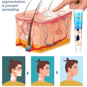 MelFix™ Vitiligo Therapy Cream