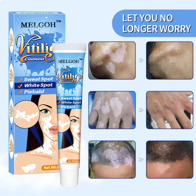 Melgoh™ Clinically Proven Vitiligo Ointment