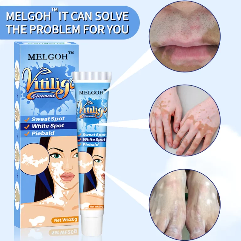 Melgoh™ Clinically Proven Vitiligo Ointment