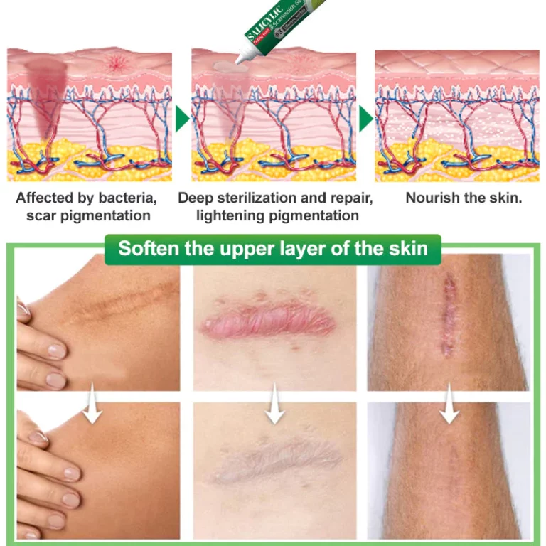 Ourlyard™ Salicylic Acid Scar Removal Gel