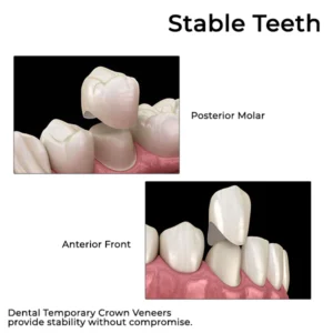 Oveallgo™ Dental Temporary Crown Veneers