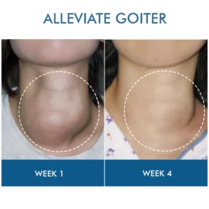 Oveallgo™ Goiterless Neck Skin Firming Serum