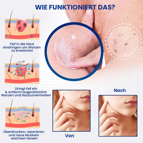 Dobshow™ WartsOff Rapid Creme zur sofortigen Entfernung von Hautunreinheiten
