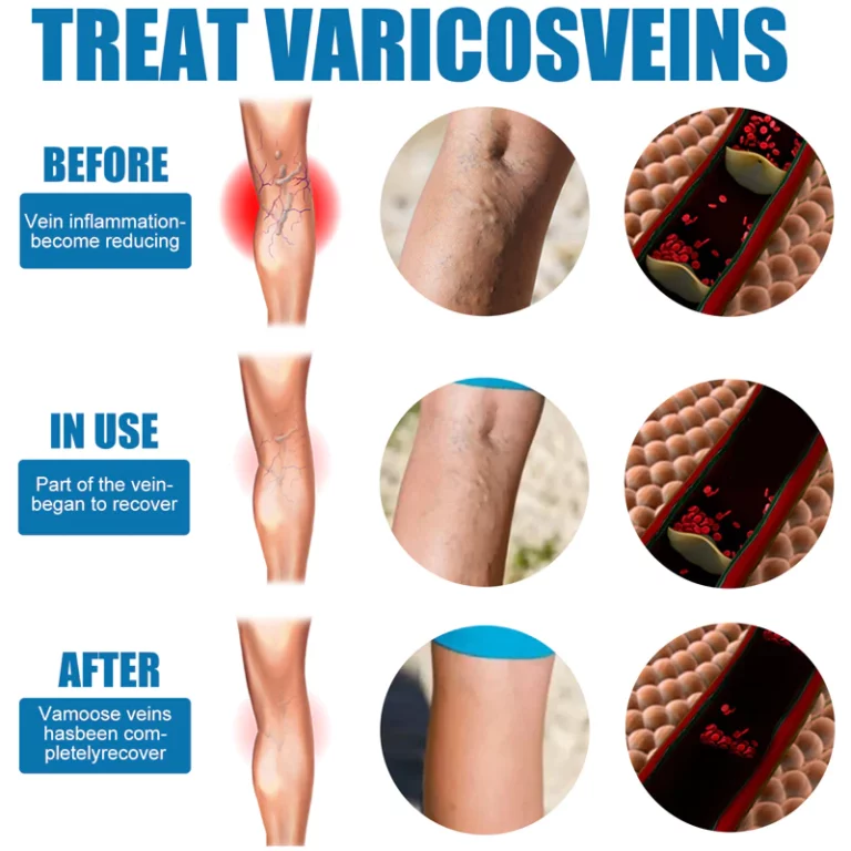 Seurico™ Vein Varicose Relief Spray