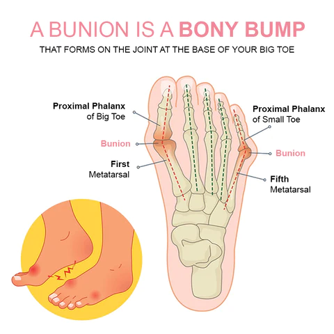 StrongJoints Bunion Relief Patch