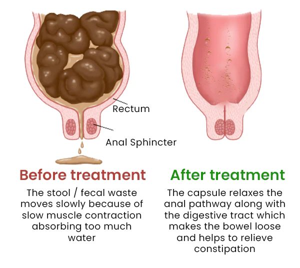 Vflux™ Constipation Relief Capsule