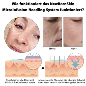 ATTDX SkinRevive MicroInfusion Needle System