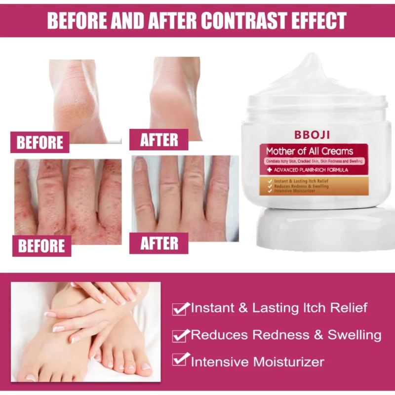 BBOJI™ Multi- Symptom Psoriasis Treatment Cream