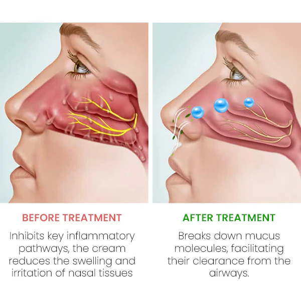 BreathLux™ Rhinitis Relief Cream