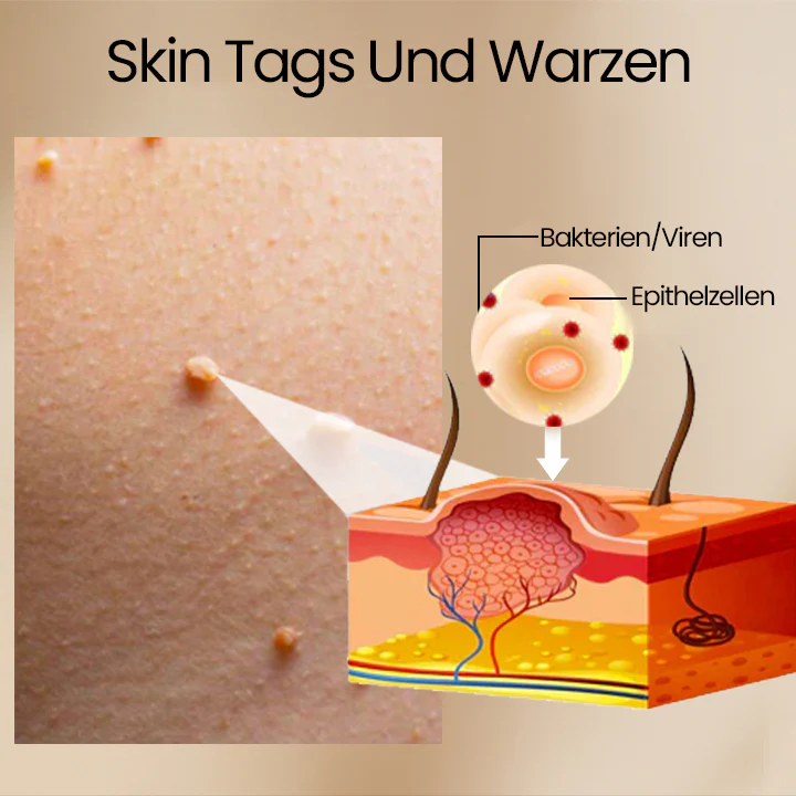 Ceoerty™ Bee Venom ClearSkin Warzen- und Tags-Entfernungs-Spray