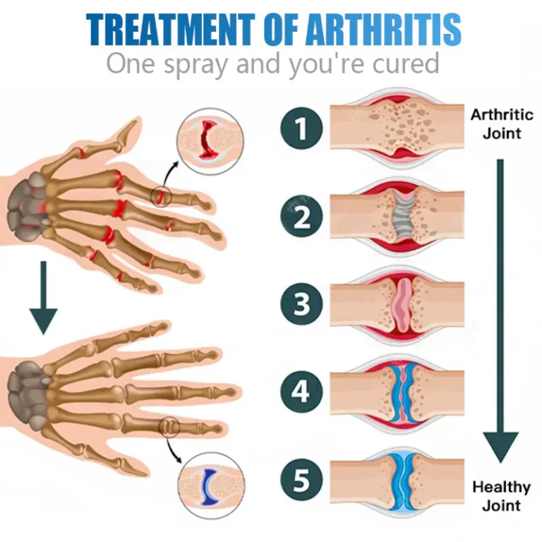 LIMETOW™Shark Collagen Spray: The Ultimate Solution for Bone Spur Relief and Joint Mobility