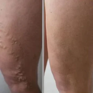 LOVILDS™ Varicose Veins Treatment Cream