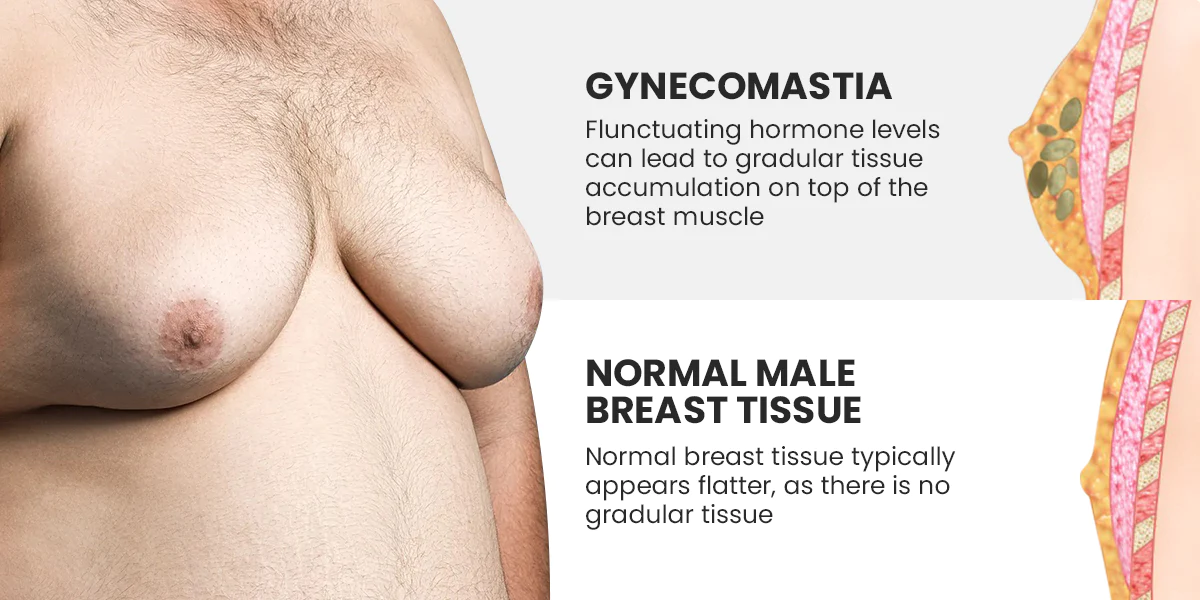 Luhaka™ Gynecomastia Cellulite Melting Patch
