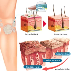 Ourlyard™ Multi-Symptom Psoriasis-Behandlungscreme