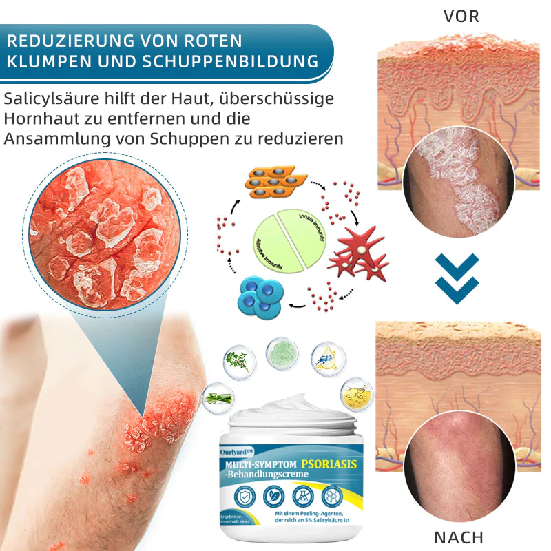 Ourlyard™ Multi-Symptom Psoriasis-Behandlungscreme