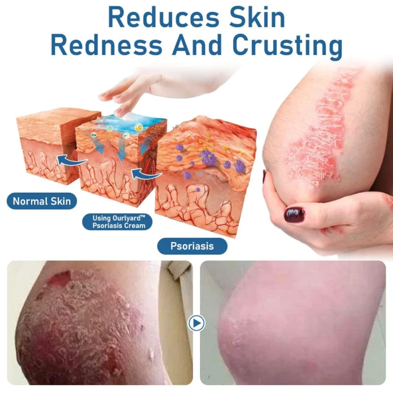 Ourlyard™ Psoriasis Moisturizing and Soothing Cream