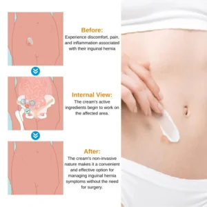 Oveallgo™ Inguinal Hernia Treatment Cream