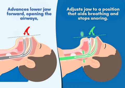 SilentBite™ Anti-Snoring Mouthpiece