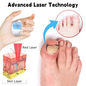 Biancat™ Nail Fungus Laser Cleaning Repair Device