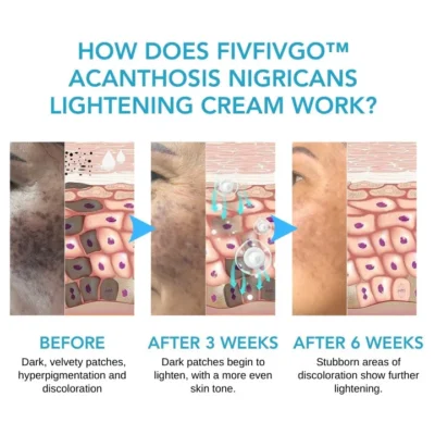 Fivfivgo™ Acanthosis Nigricans Aufhellungscreme